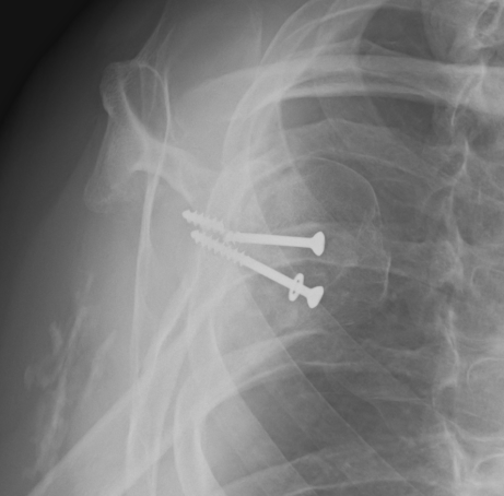 Failed Latarjet Lateral